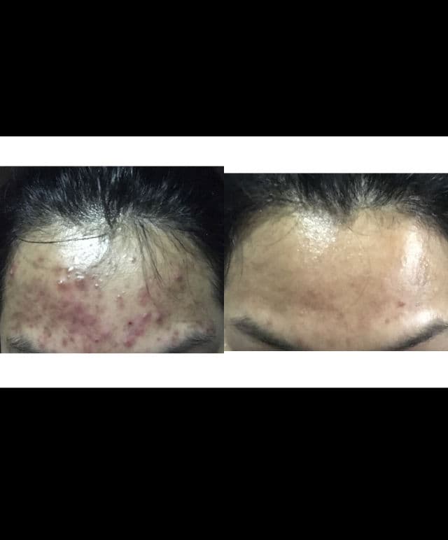 La Roche-Posay Effaclar Adapalene Gel 0.1% Retinoid Acne Treatment review photo by aiskinjourney