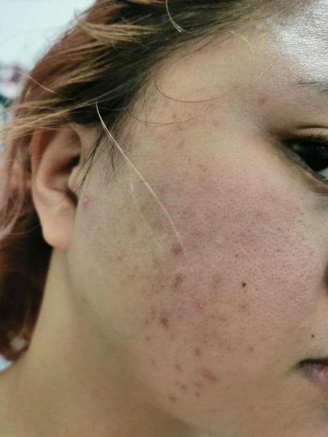 Derma XP Aza 20 Cream review photo by alexandruuh