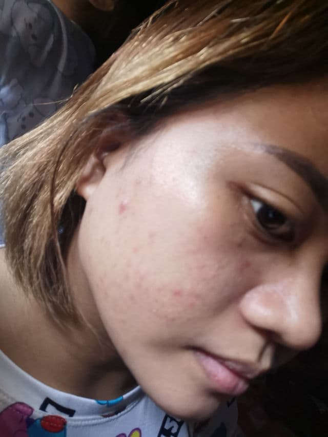 Derma XP Aza 20 Cream review photo by alexandruuh