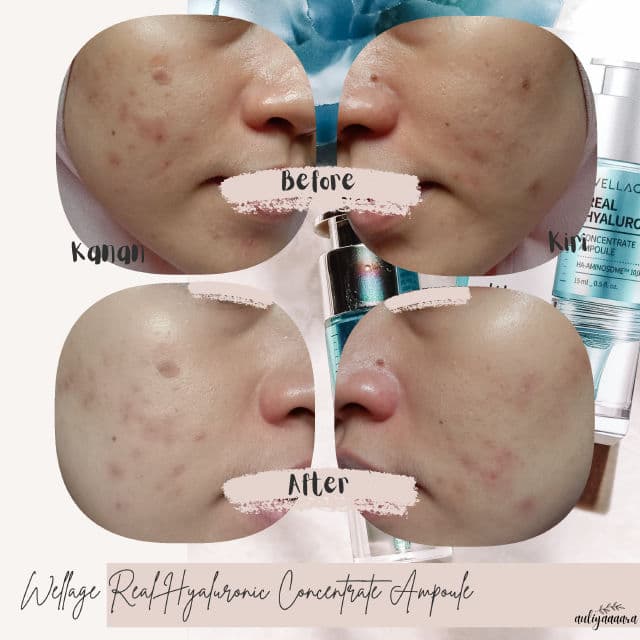 Wellage Real Hyaluronic Concentrate Ampoule review photo by auliyaaaara