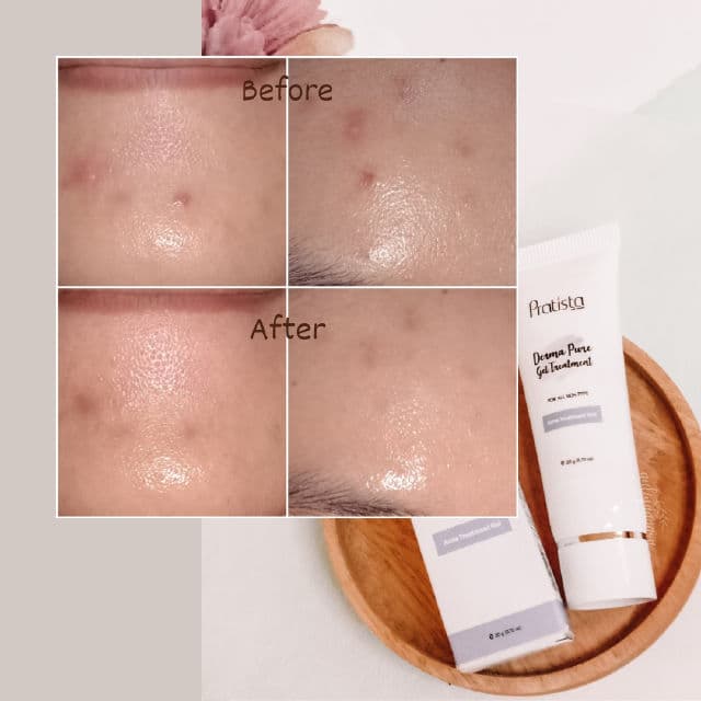 Pratista Derma Pure Gel Treatment review photo by auliyaaaara