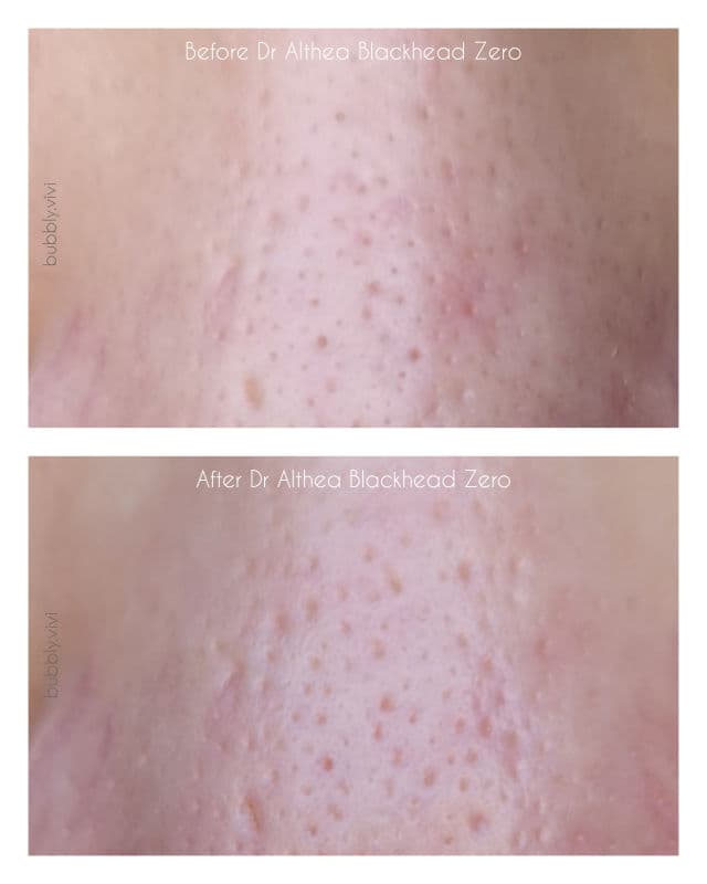 Dr. Althea Blackhead Zero 2-Step Nose Patch review photo by bubblyvivi