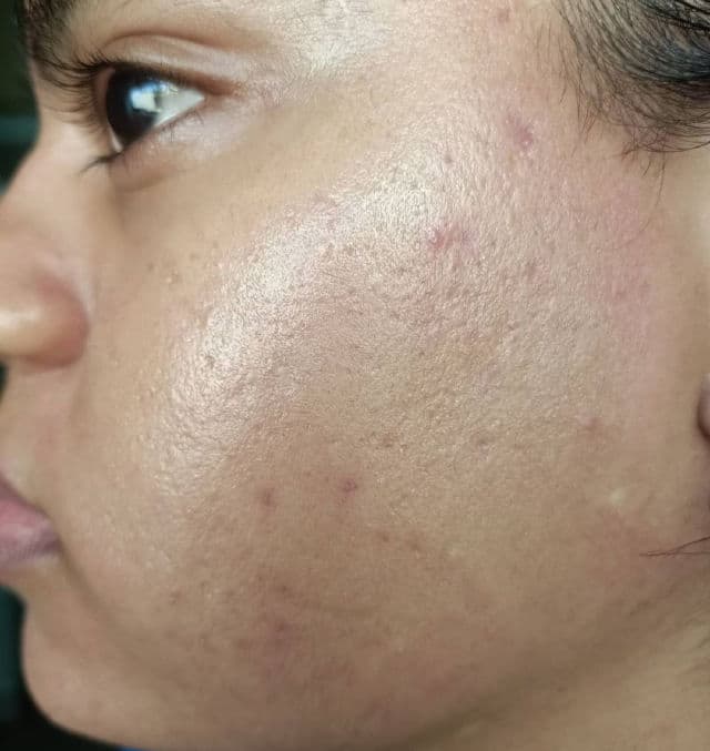 The Ordinary Mandelic Acid 10% + HA review photo by canvas28