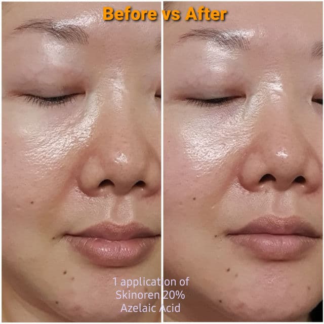 Bayer Skinoren 20% Cream review photo by chlil2002