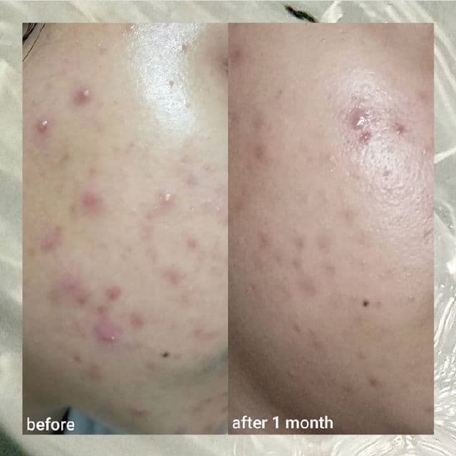 Rovectin [Discontinued] Clean LHA Blemish Ampoule review photo by dennyjeyn