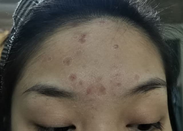 Fresh Formula Blemish Doctor Anti-Acne Facial Toner review photo by reviewsbynor