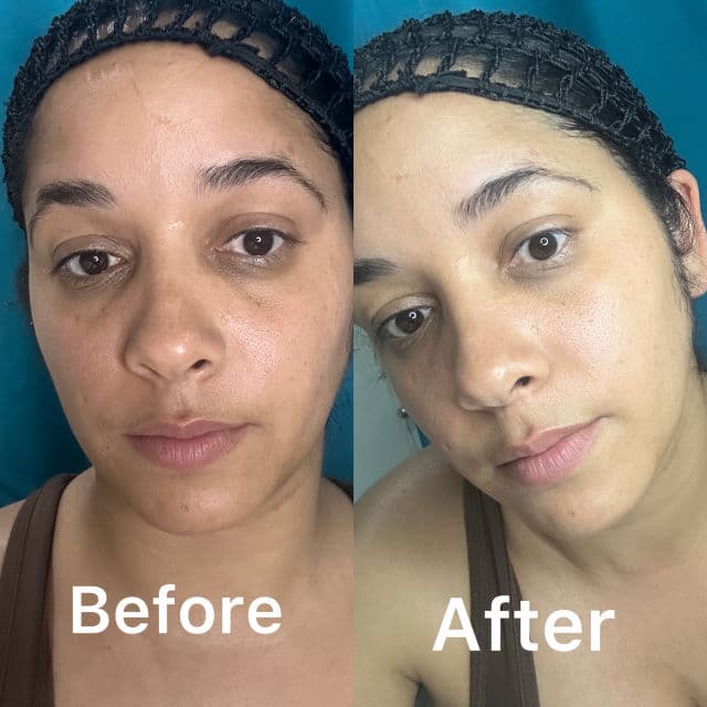 MEDIHEAL Retinol Collagen Under Eye Patch review photo by caroaquinov