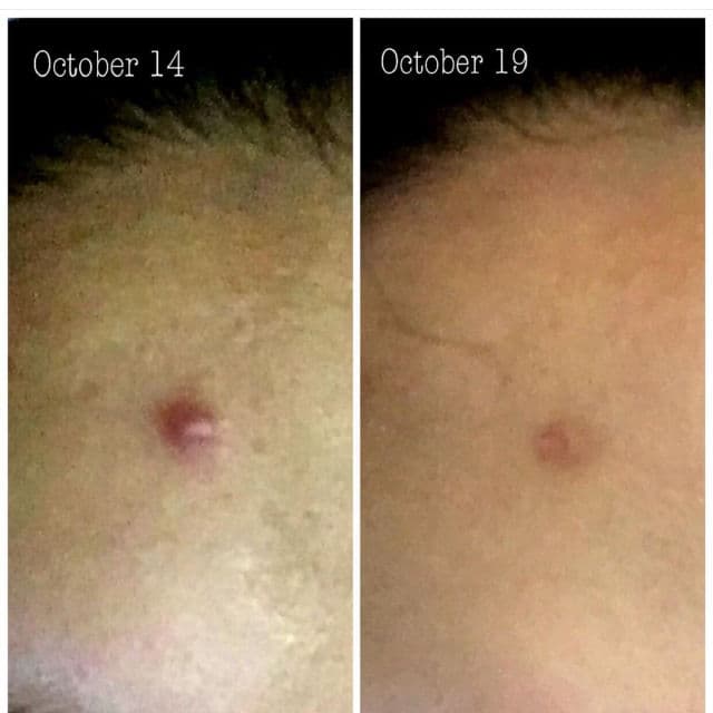 COMMONLABS Vitamin E Micro Needle Spot Cream review photo by ennskincare