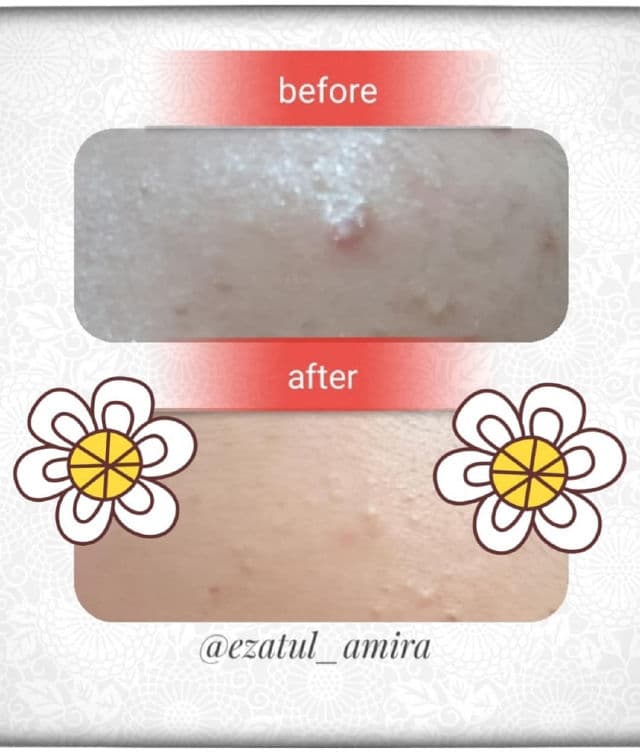 TIAM AC Fighting Spot RX Cream review photo by ezatulSkincareDiary