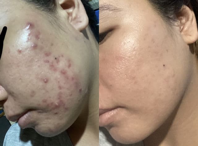 Galderma Adapalene 0.3% + Benzoyl Peroxide 2.5% (Epiduo Forte) review photo by gaely