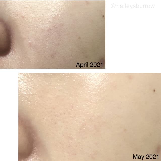Rovectin [Discontinued] Clean LHA Blemish Ampoule review photo by halleysburrow