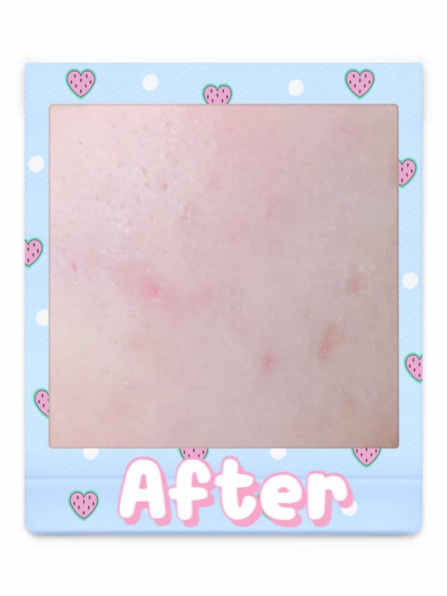La Roche-Posay Effaclar Duo (+) Anti-Acne Moisturiser review photo by iJAYi
