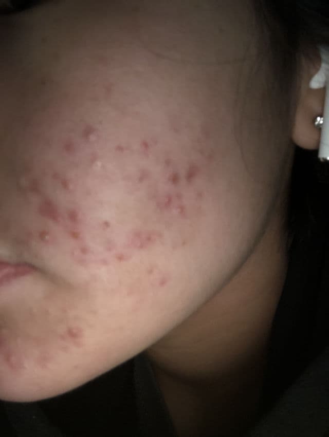 PanOxyl Benzoyl Peroxide 10% Acne Foaming Face Wash review photo by jaidyn