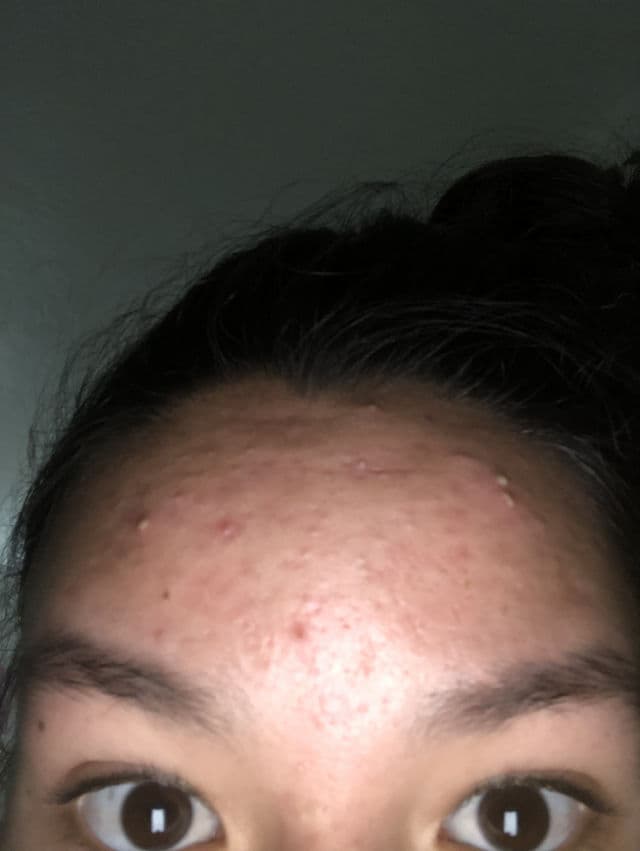 PanOxyl Benzoyl Peroxide 10% Acne Foaming Face Wash review photo by jaidyn