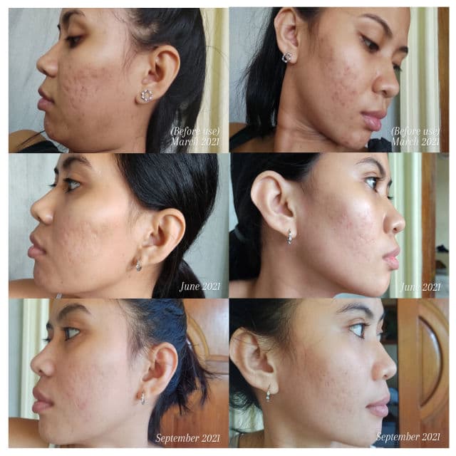 Breylee Acne Scar Removal Gel review photo by jasmincmagbanua