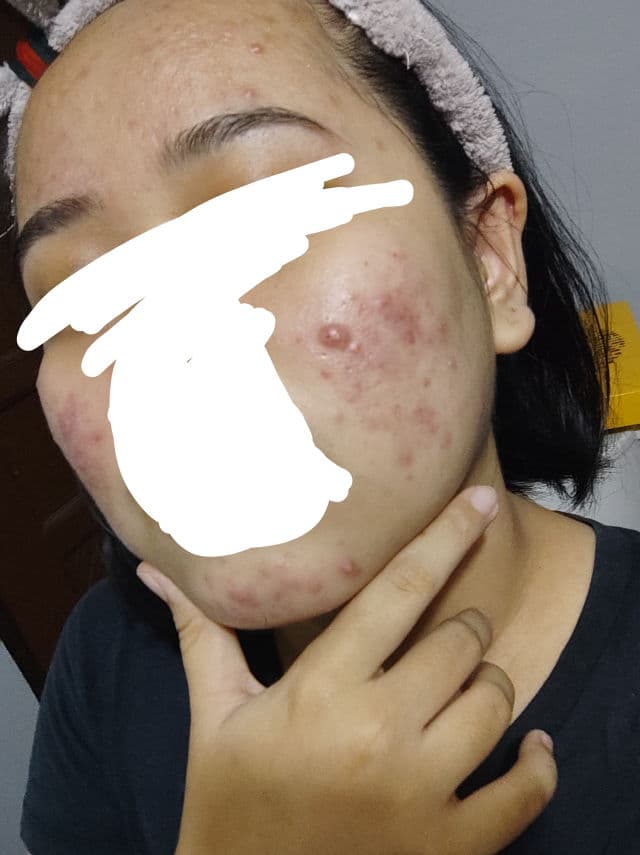 Luxe Organix Miracle Solutions Cleanser AHA/BHA Deep Pore Cleansing & Brightening review photo by jayen