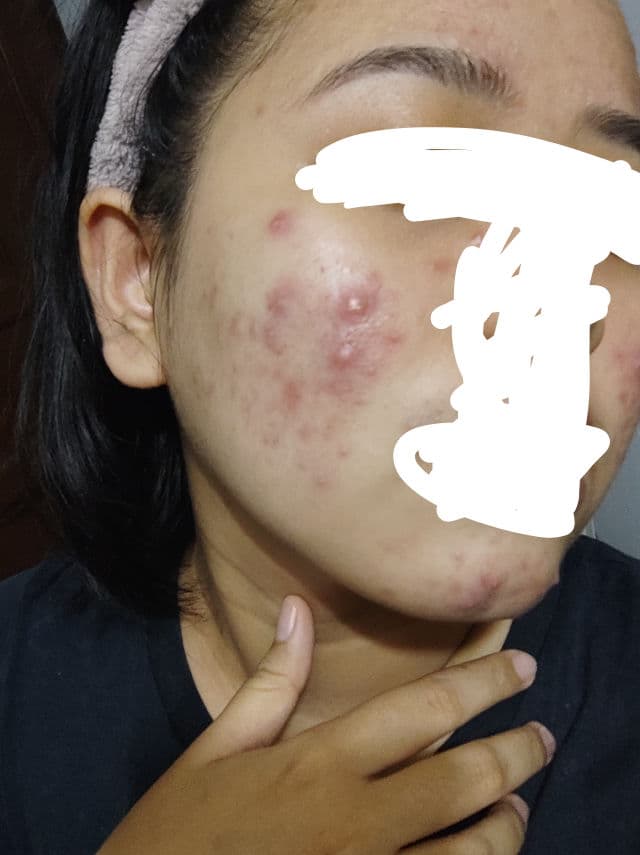 Luxe Organix Miracle Solutions Cleanser AHA/BHA Deep Pore Cleansing & Brightening review photo by jayen