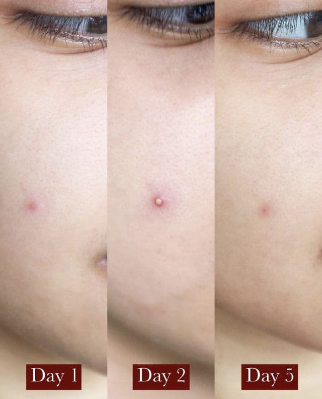 Odacite Skincare Bl+C | Pimples Black Cumin + Cajeput Serum Concentrate review photo by kimsgooddays