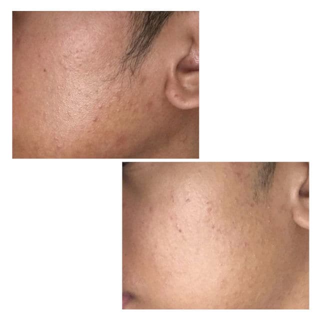 The Ordinary Alpha Arbutin 2% + HA review photo by kylepaiso