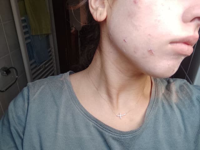 A-Derma Protect AC - SPF 50+ review photo by lila13