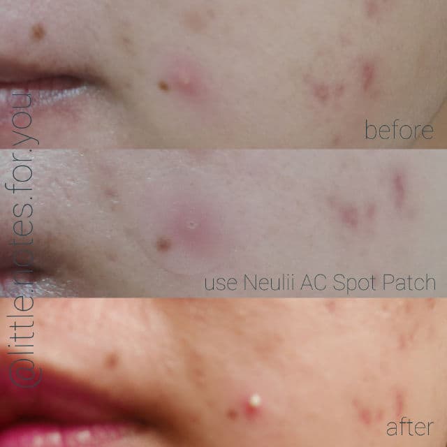 Neulii AC Clean Saver Spot Patch review photo by littlenotesforyou