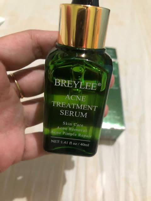 Breylee Acne Treatment Serum review photo by strawberryberi