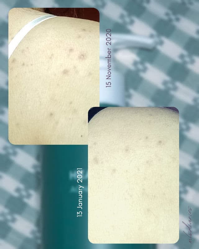 ANUA Heartleaf Acne Body Wash review photo by mlsdiaries