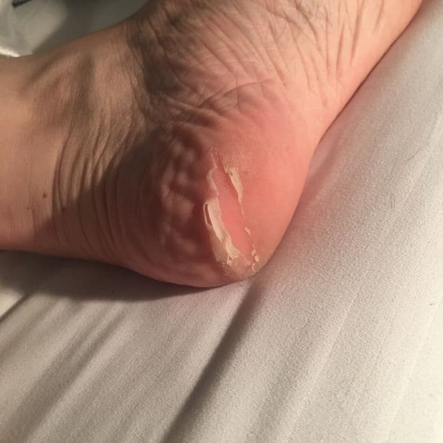 MJ Care Soft Miracle Foot Peeling Pack review photo by mudonyourface