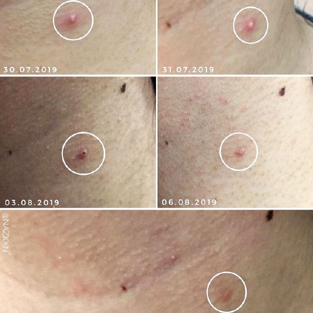 Jumiso AC Cure No Pain No Gain Spot Cream review photo by nazxxn