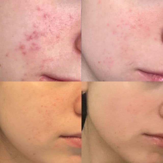 Versed Keep the Peace Acne-Calming Cream Cleanser review photo by nimiii