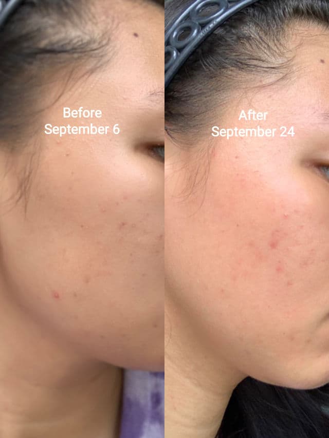 Gratitude Bar Acne Clear Drops review photo by nyannieee