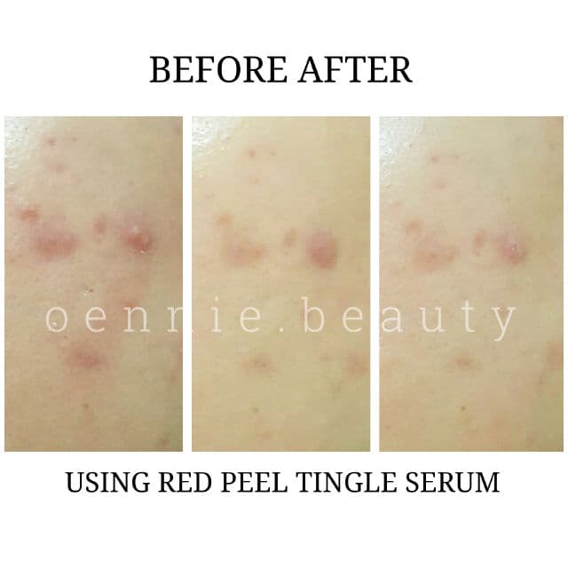 So Natural Red Peel Tingle Serum review photo by oenniebeauty