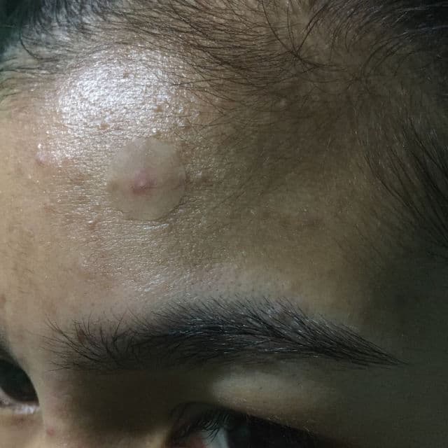 Neulii AC Clean Saver Spot Patch review photo by skincarebykaye