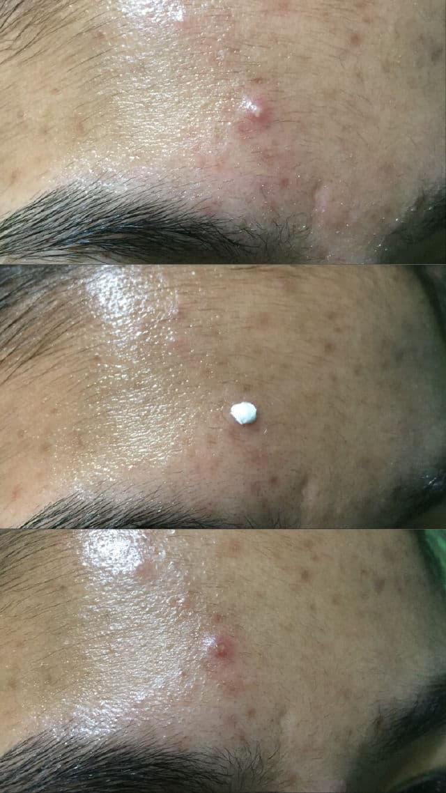 The Skin House Dr. Clear Magic Powder Spot review photo by skincarebykaye