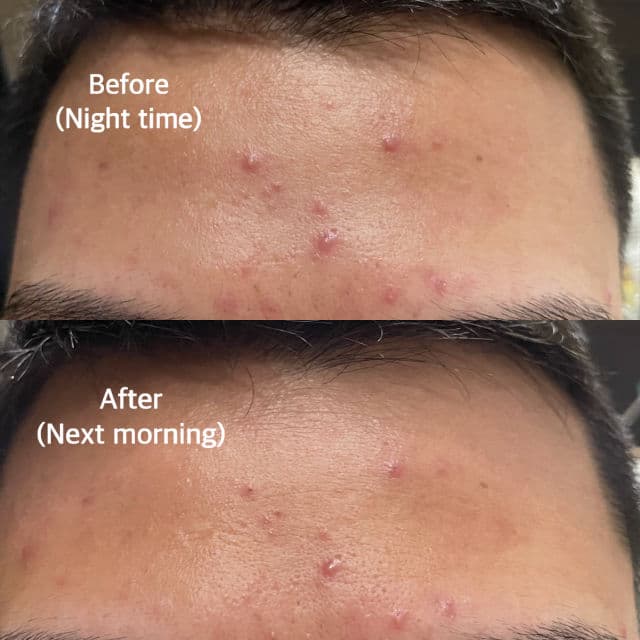 AXIS-Y Spot the Difference Blemish Treatment review photo by skincareitry