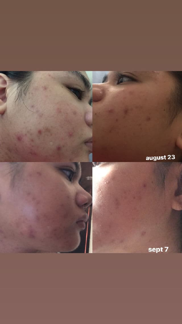 Skinpotions Tomato Serum review photo by skincarenewbie
