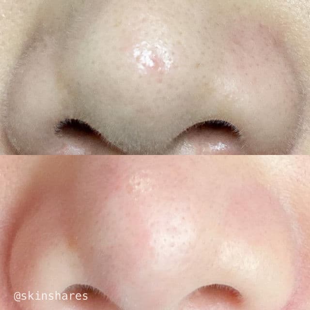 TIAM Blackhead Out Sheet review photo by skinshares