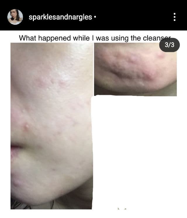 G9 SKIN AC Solution Acne Foam Cleanser review photo by sparklesandnargles