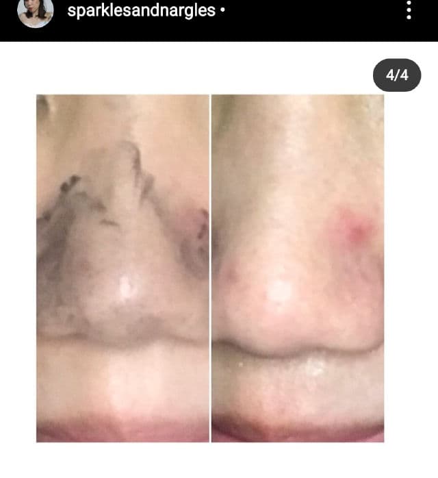 A'bloom BHA Blackhead Blaster review photo by sparklesandnargles