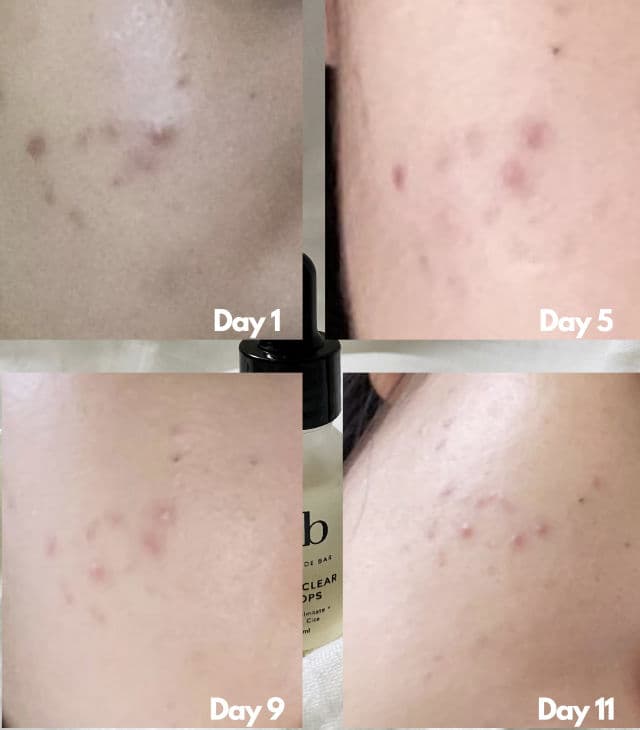 Gratitude Bar Acne Clear Drops review photo by ssffolskin