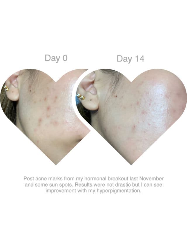 Rovectin ROVECTIN LHA Blemish Ampoule review photo by tenaciouskace