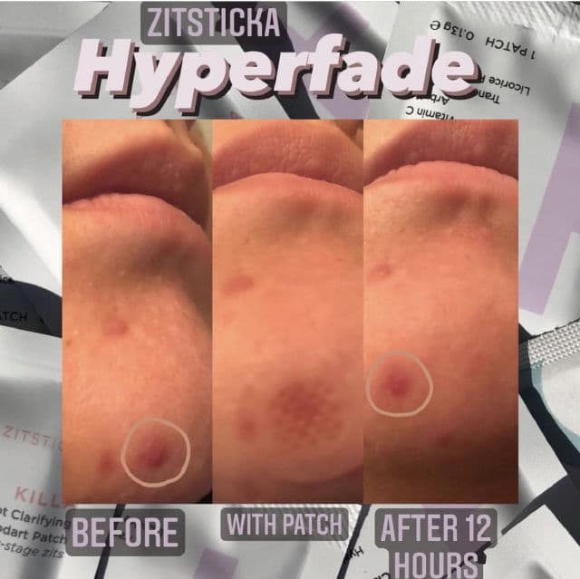 ZitSticka Hyperfade review photo by transepidermaltrish