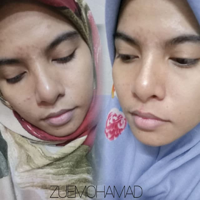 Some By Mi AHA BHA PHA 14 Days Super Miracle Spot All Kill Cream review photo by zuemohamad