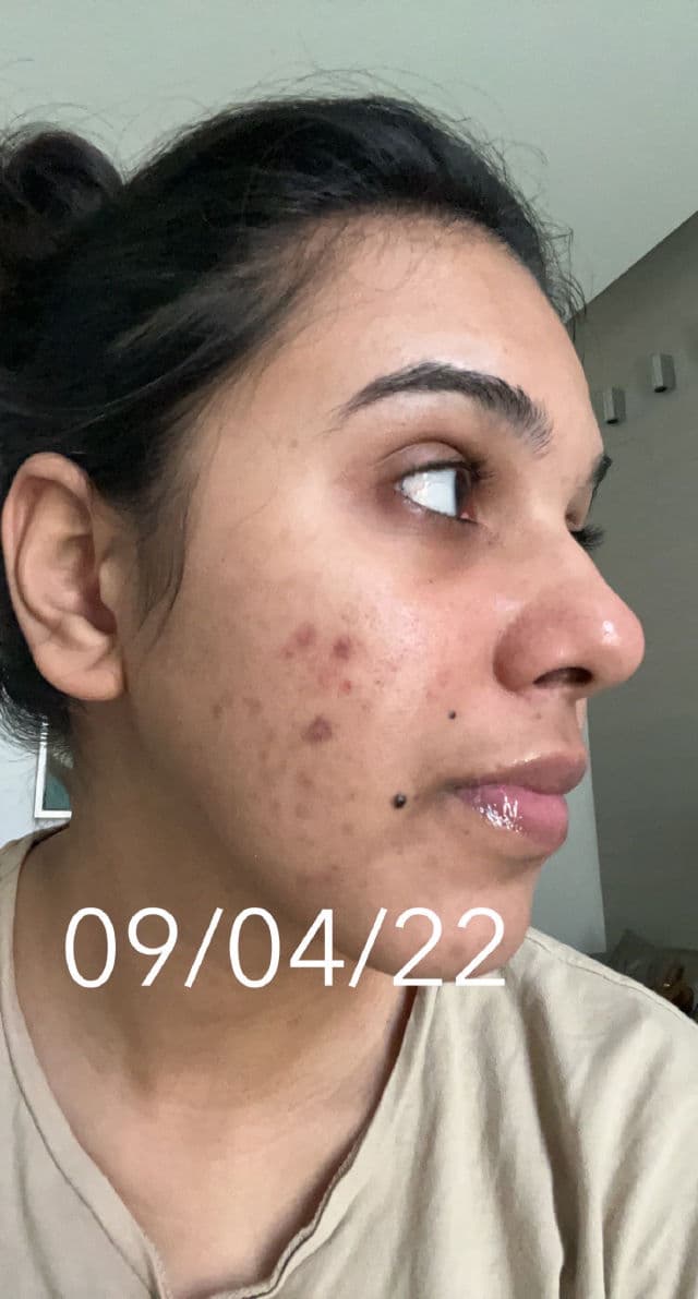 Minimalist Tranexamic 3% + HPA review photo by prarthana2100