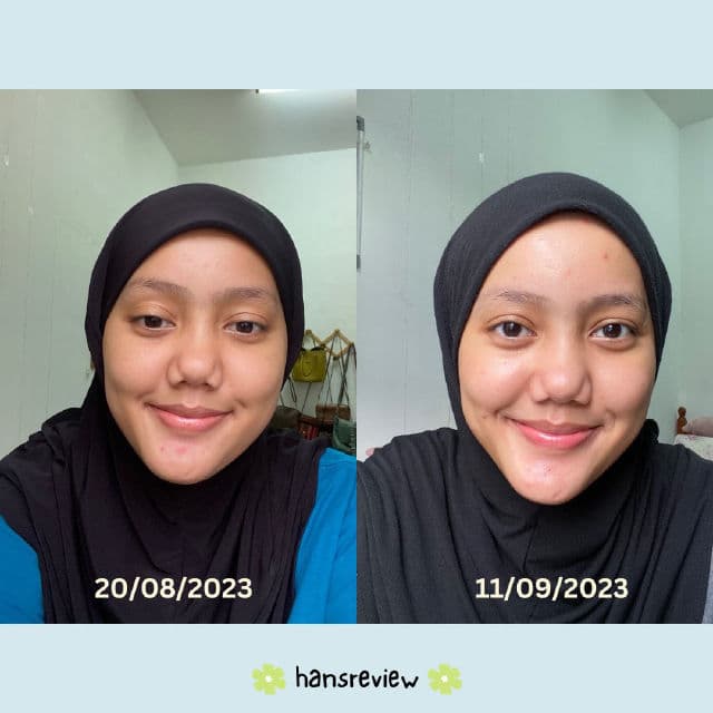 ANUA Green Lemon Vita C Blemish Serum review photo by gojeshani