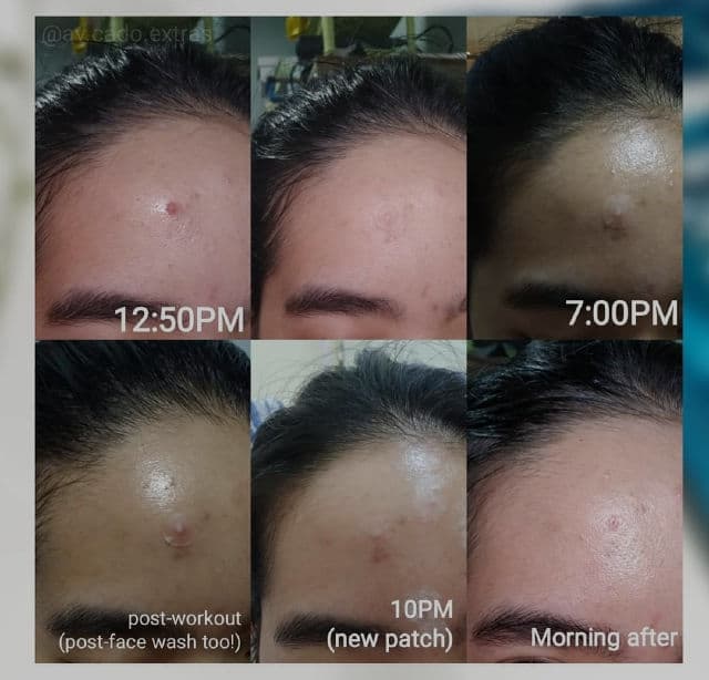 By WISHTREND Clear Skin Shield Patch review photo by AVCado