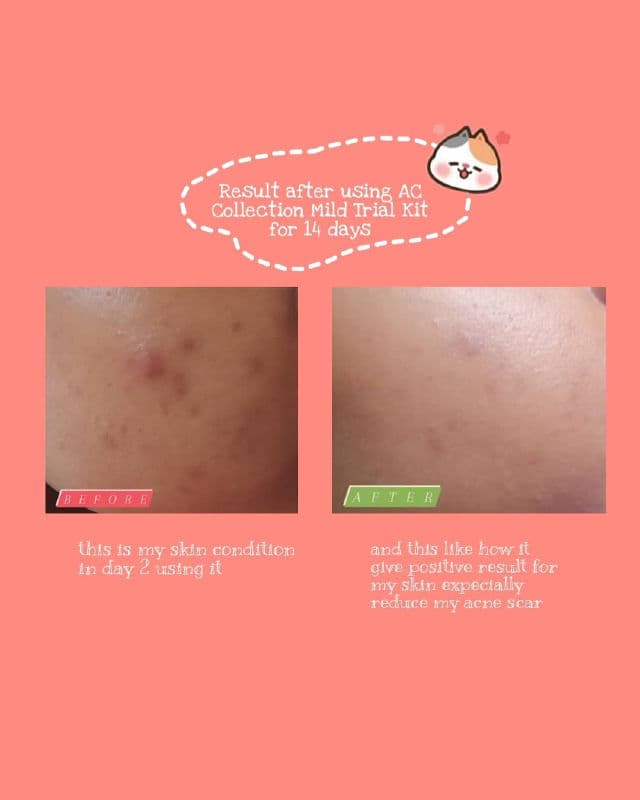 COSRX AC Collection Calming Foam Cleanser review photo by asyanie