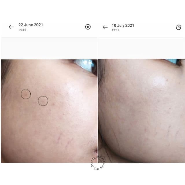 Naturium Tranexamic Topical Acid 5% review photo by dinaotaya