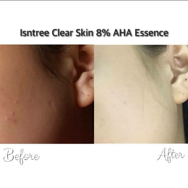 ISNTREE Chestnut AHA 8% Clear Essence review photo by ennskincare