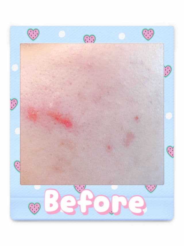 La Roche-Posay Effaclar Duo (+) Anti-Acne Moisturiser review photo by iJAYi